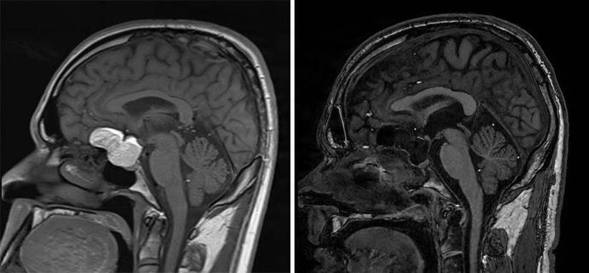 Walter Reed’s Skull Base Team performs minimally invasive brain tumor removal